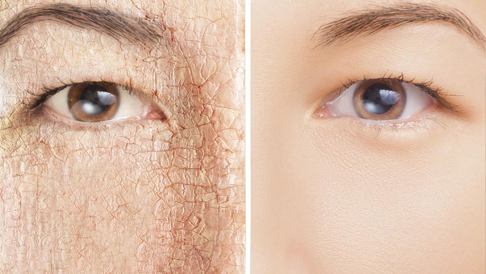 راه های رفع و درمان پوسته پوسته شدن پوست صورت